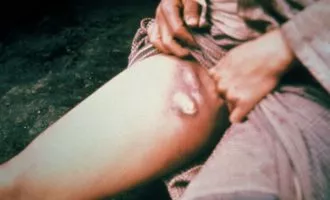 طاعون خیارکی