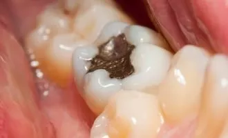 اثر مخرب امواج دستگاه MRI بر مواد پرکننده دندان