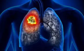 تشخیص سرطان ریه به کمک هوش مصنوعی