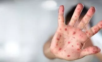 آبله میمون