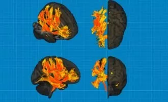 مغز فرد مبتلا به پرفشاری خون
