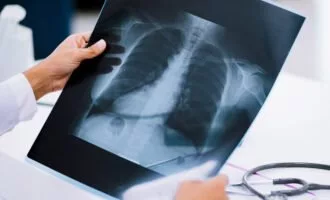 اسکن قفسه سینه