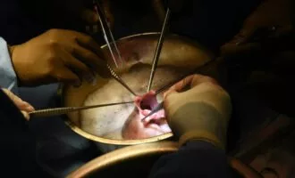 پیوند قلب خوک