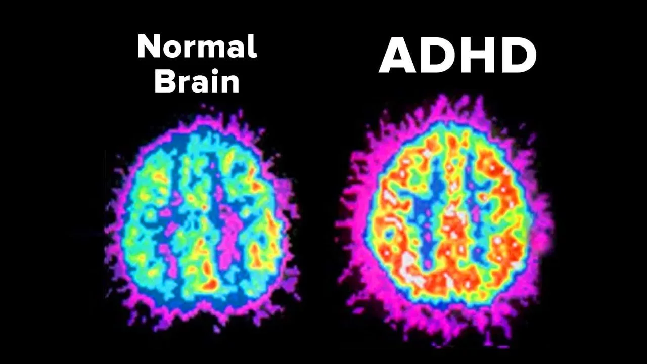 ADHD