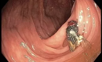 کشف مگس در روده انسان