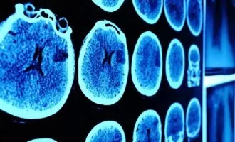 درمان تومور مغری در نوجوان 13 ساله