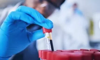 آزمایش خون و آرتروز