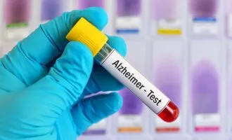 آزمایش خون آلزایمر