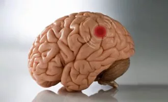 داروی ضدافسردگی برای درمان تومور مغزی