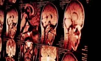 ضربه مغزی در مردان