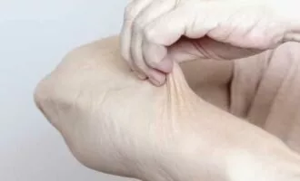 سندروم اهلرز دانلوس