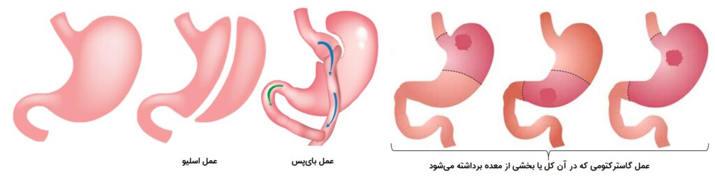 عملهای معده که منجر به سندرم دامپینگ میشوند.
