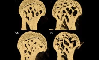 کاهش تراکم استخوان در فضا