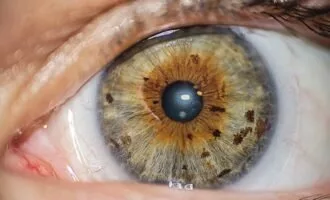 تزریق طلا به چشم برای درمان نابینایی