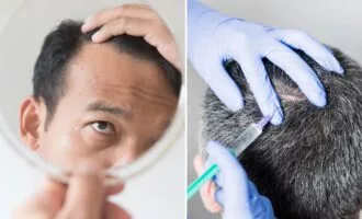 «بوتاکس جدید» برای مقابله با ریزش مو