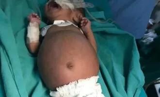 جنین در شکم نوزاد