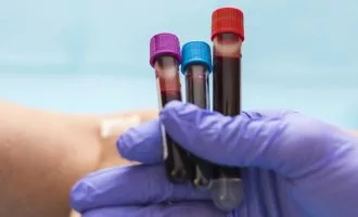 آزمایش خون برای تشخیص سرطان سر و گردن