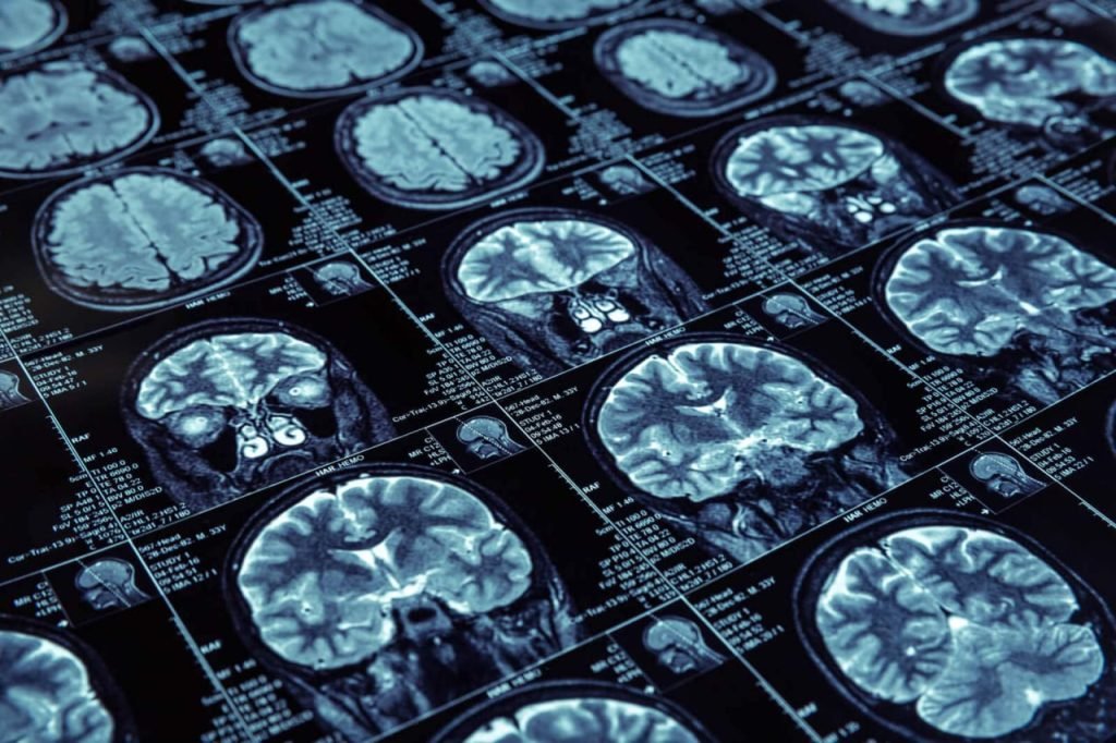عکس MRI از مغز