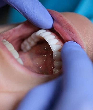 مطالعه جدید: بیماری لثه ممکن است خطر سکته مغزی را افزایش دهد