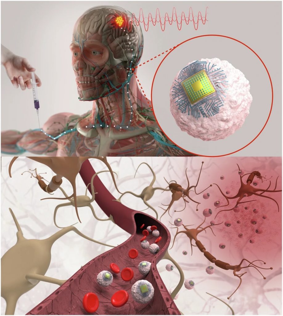 درمان بیماری‌های مغزی با تراشه‌های تزریقی