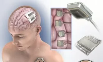 ایمپلنت جدید برای ارتباط با مغز