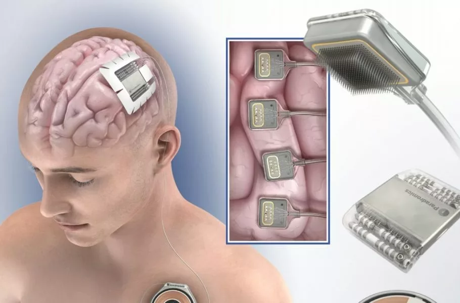 ایمپلنت جدید برای ارتباط با مغز