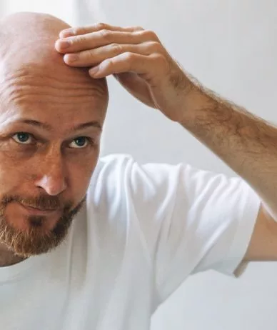 داروی جدید طاسی مردان