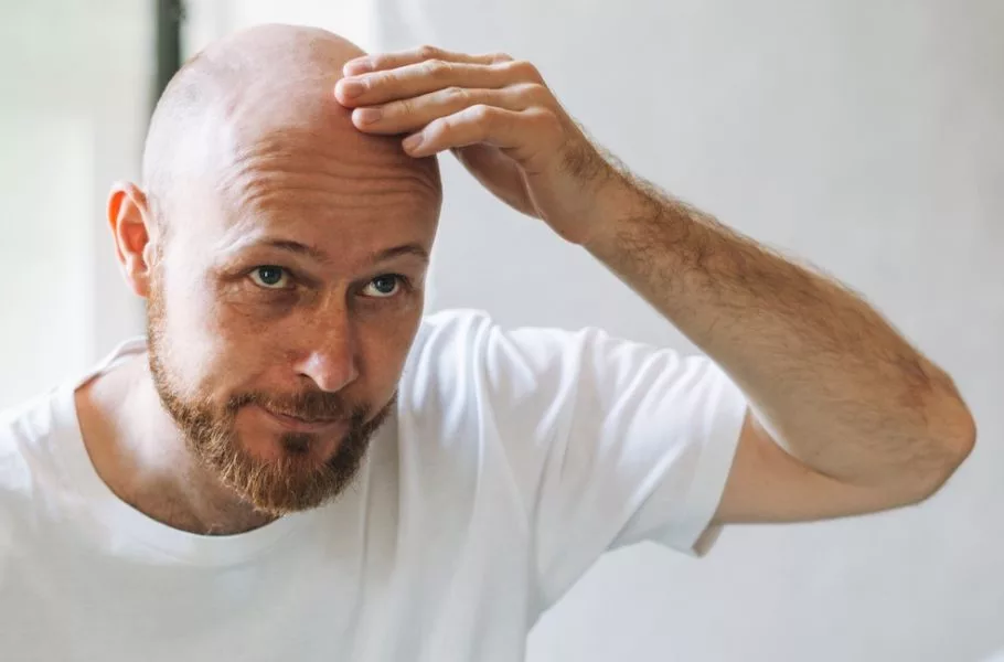 داروی جدید طاسی مردان