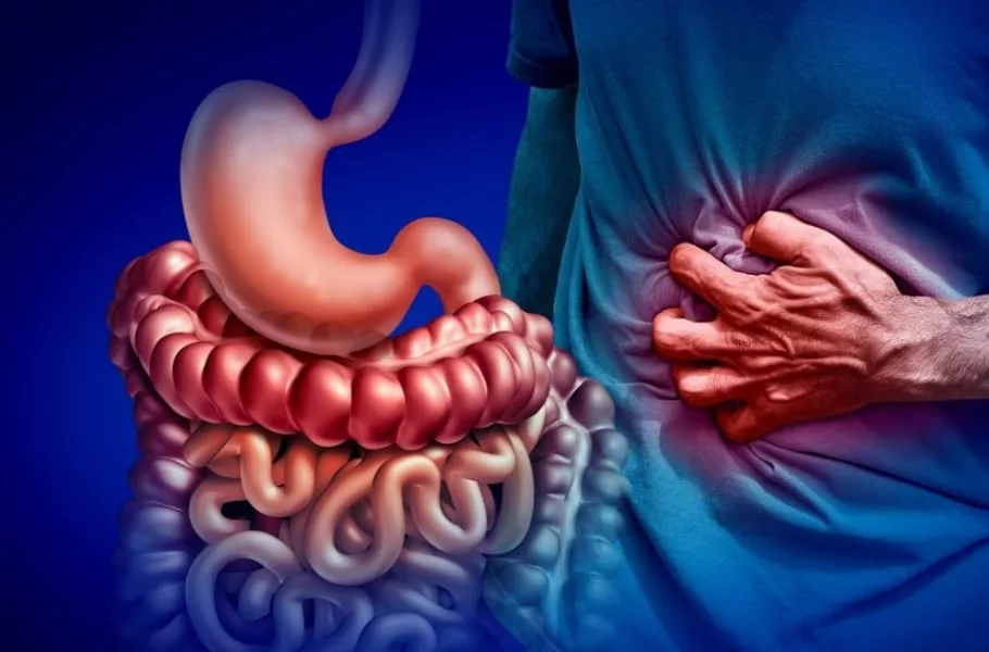 بیماری کرون