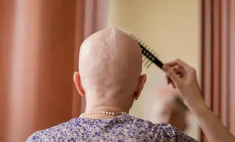 موی ریخته شده بیمار