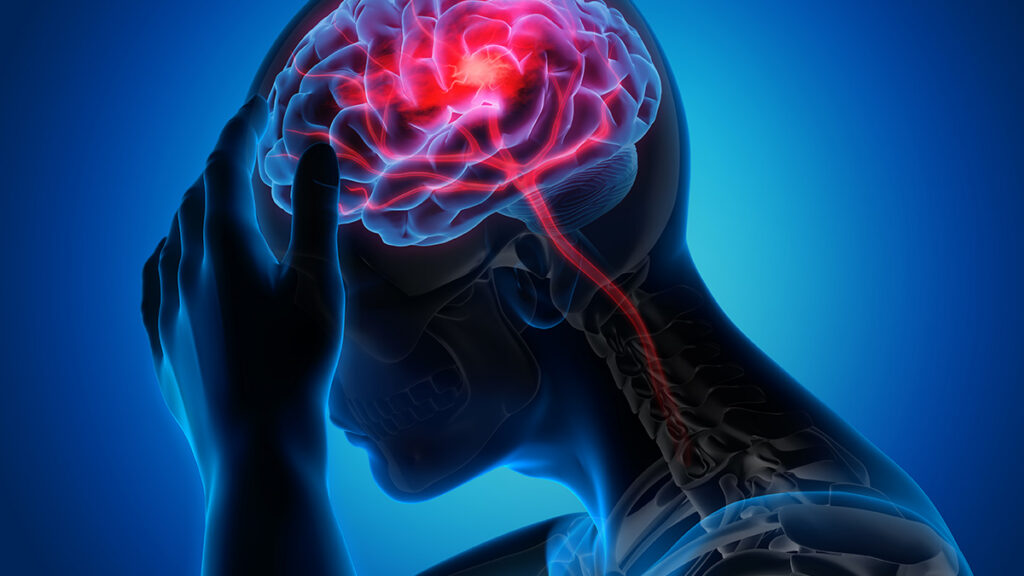 هوش مصنوعی جدید دانشمندان با تحلیل DNA می‌تواند ریسک سکته مغزی را پیش‌بینی کند